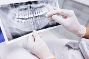 סוגי כתרים בשיניים קדמיות